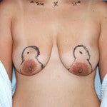 Breast Lifts 4