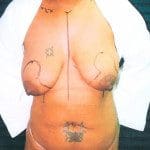 Breast Lifts 3
