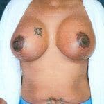 Breast Lifts