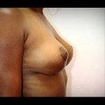 Breast Lifts