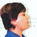 Natural Look Laser Lift