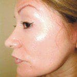 Natural Look Laser Lift