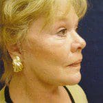 Natural Look Laser Lift