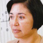 Natural Look Laser Lift