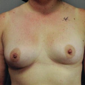 breast implant xchange 12-6