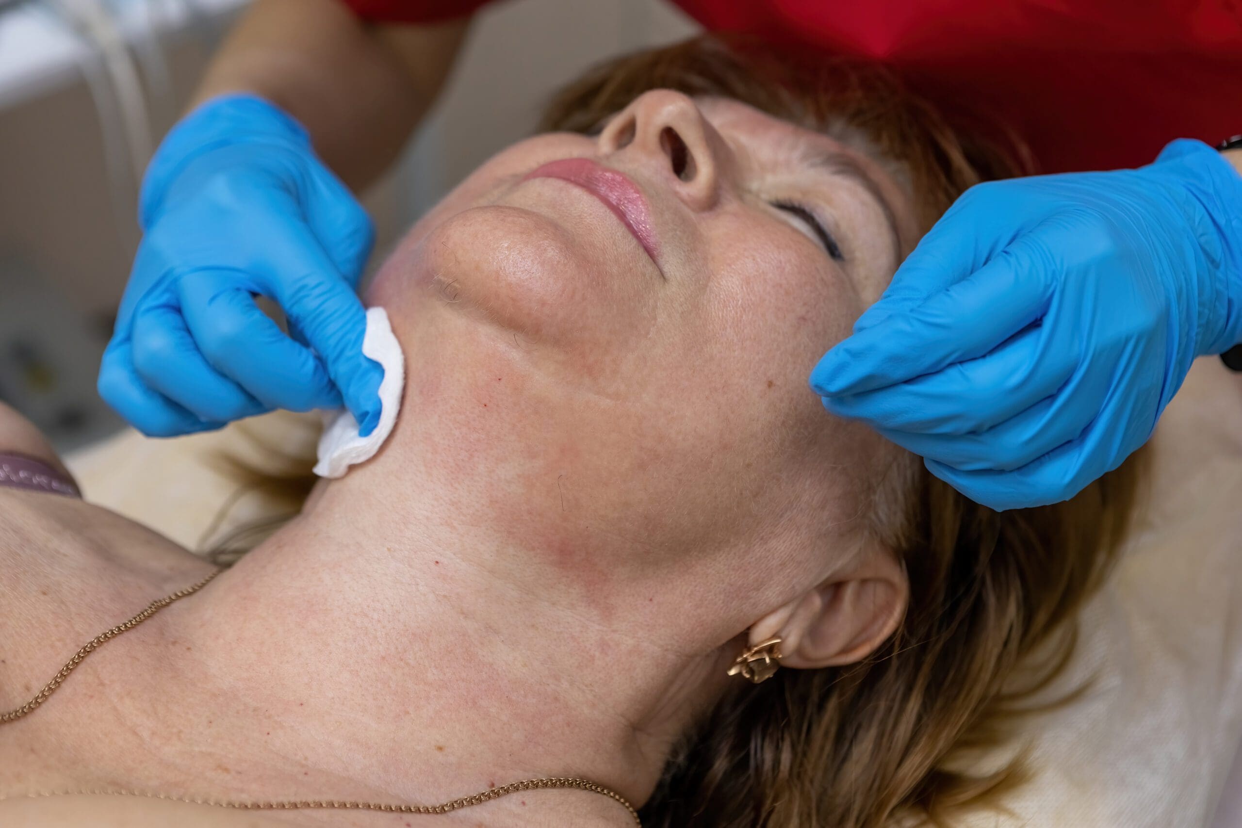 Kybella Chin Fat Removal in Temecula | Expert Guide