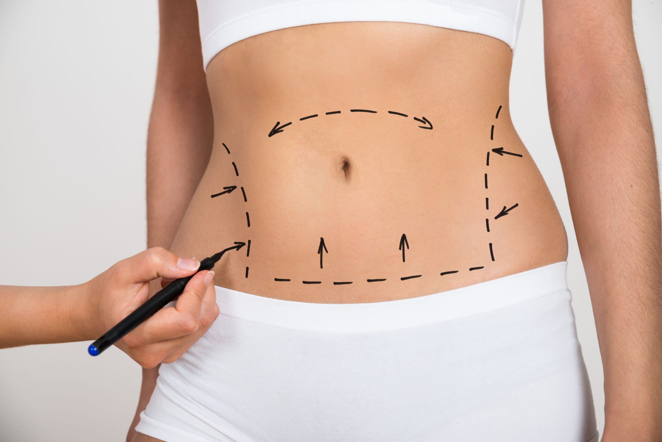 Temecula Body Contouring Insights: Liposuction and Lasting Transformations